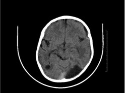 Brain abscess In a Child with Cyanotic Congenital  Heart disease 