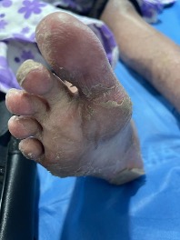 Dual diagnosis dilemma- parallel pathologies- Rare combination of dermatomyositis and DRESS syndrome in the same patient.